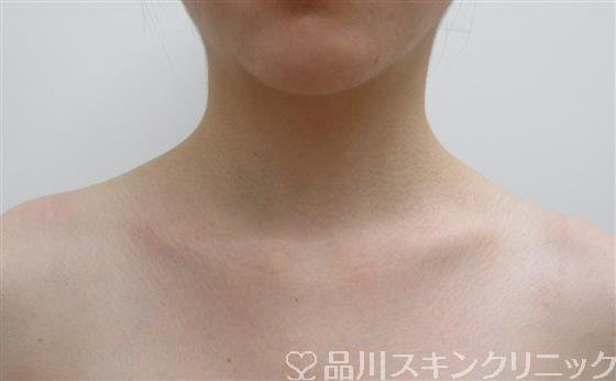 症例NO.41628のAFTER写真