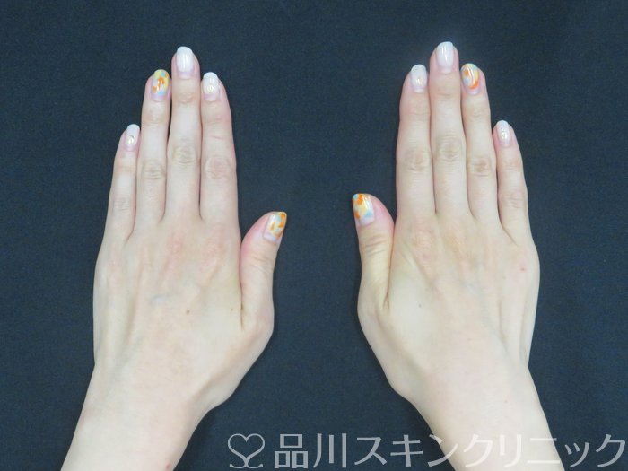症例NO.70348のBEFORE写真