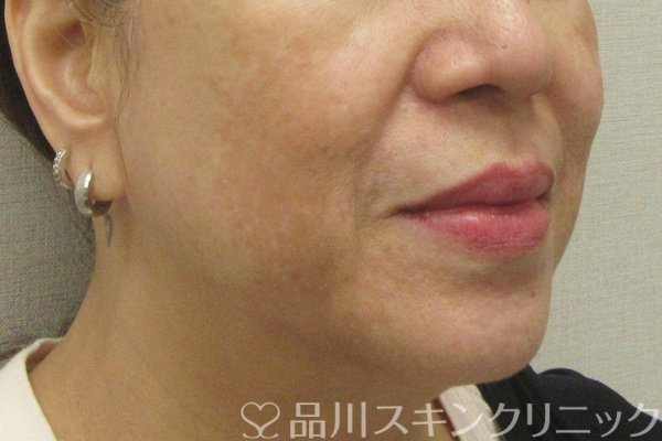 症例NO.75224のBEFORE写真