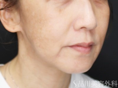 症例NO.71497のAFTER写真