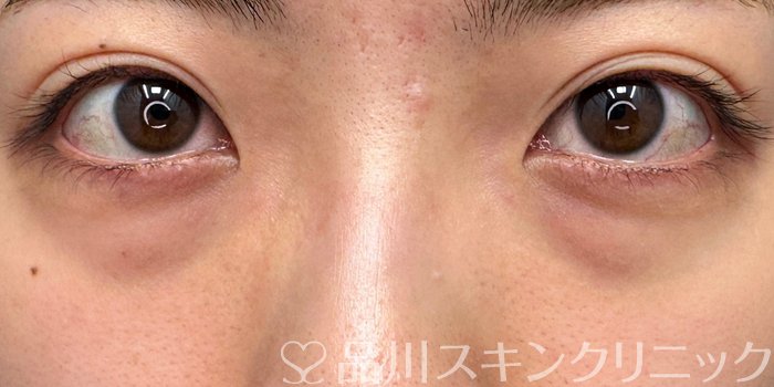 症例NO.64937のBEFORE写真