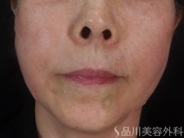 症例NO.73845のAFTER写真