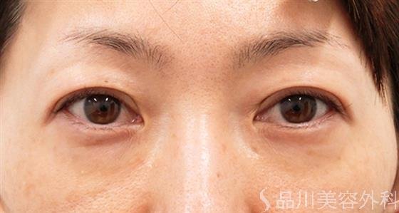症例NO.57463のAFTER写真