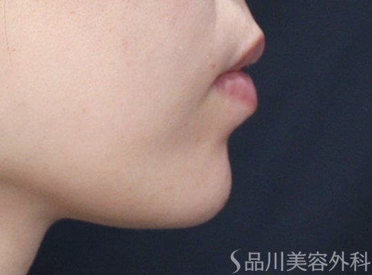 症例NO.73686のAFTER写真