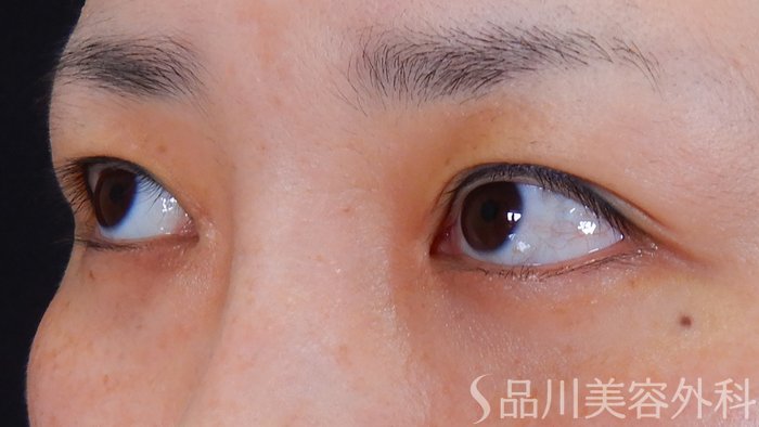 症例NO.65697のBEFORE写真