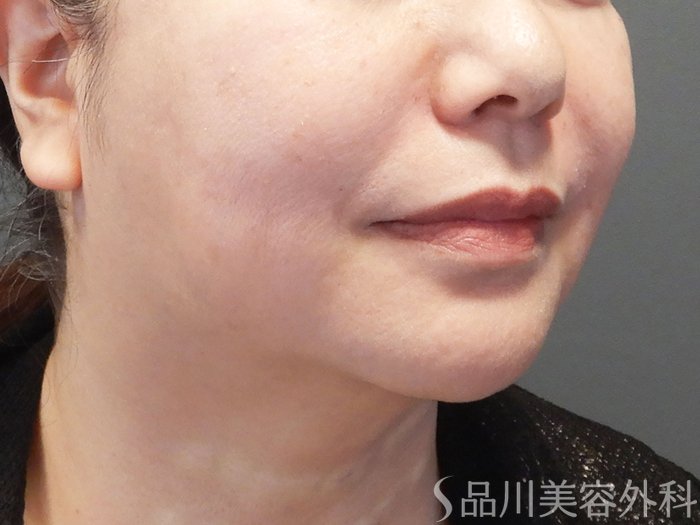 症例NO.74128のAFTER写真