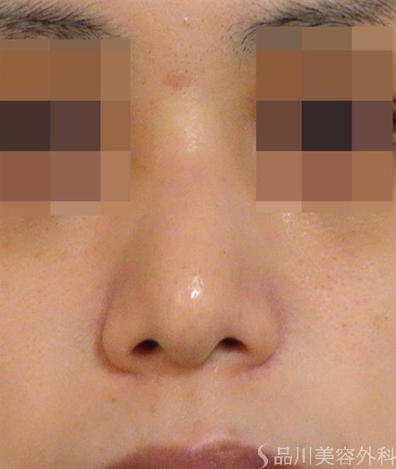 症例NO.39186のAFTER写真