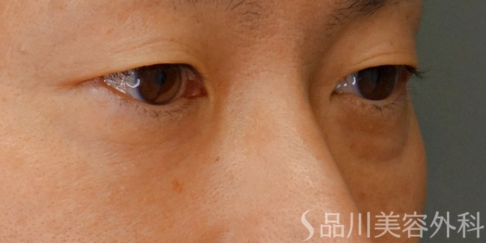 症例NO.71057のBEFORE写真