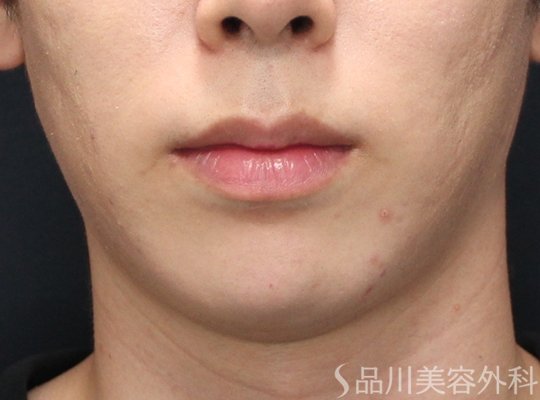 症例NO.75181のAFTER写真