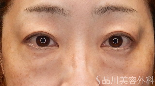 症例NO.75229のBEFORE写真
