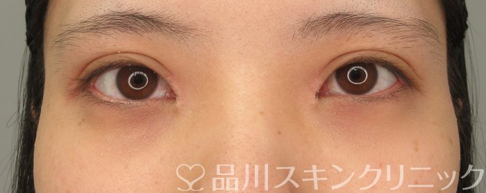 症例NO.74022のAFTER写真