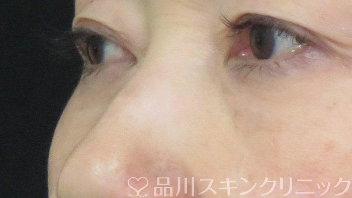 症例NO.71899のAFTER写真