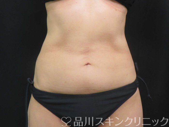 症例NO.74036のAFTER写真