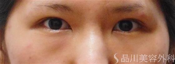 症例NO.36059のBEFORE写真