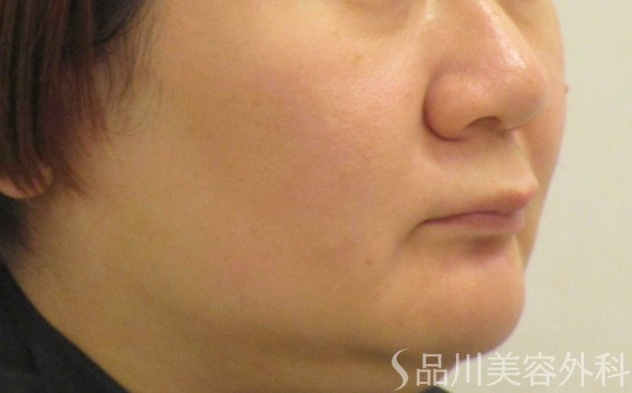 症例NO.65451のAFTER写真