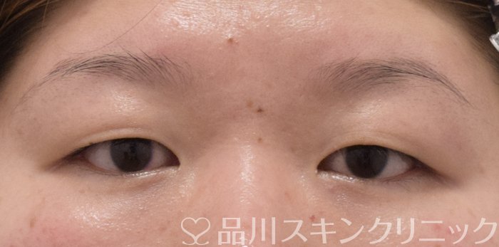 症例NO.73252のBEFORE写真