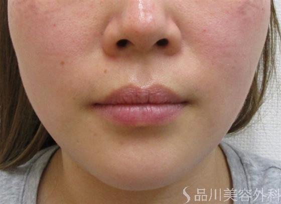 症例NO.43621のBEFORE写真