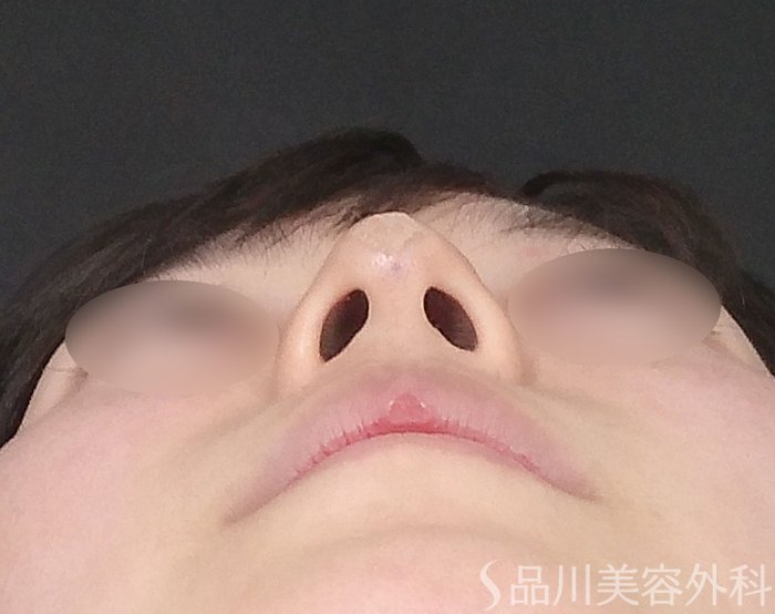 症例NO.65274のAFTER写真