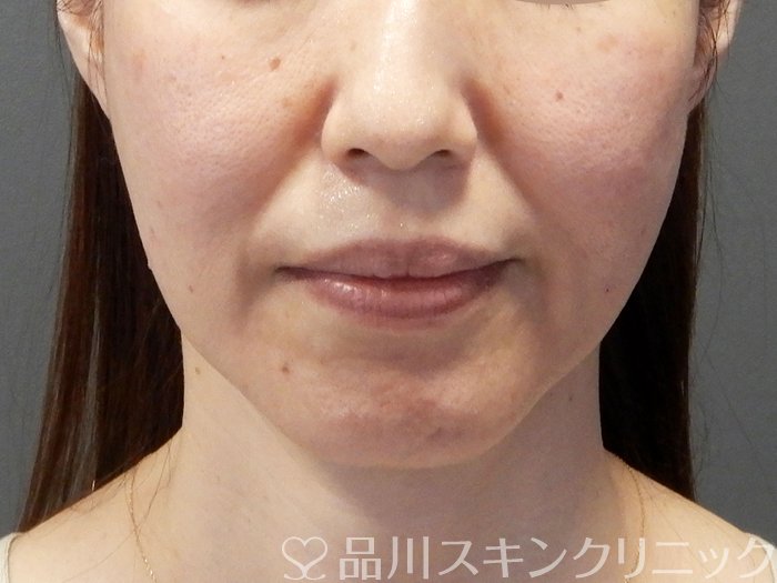 症例NO.64915のAFTER写真