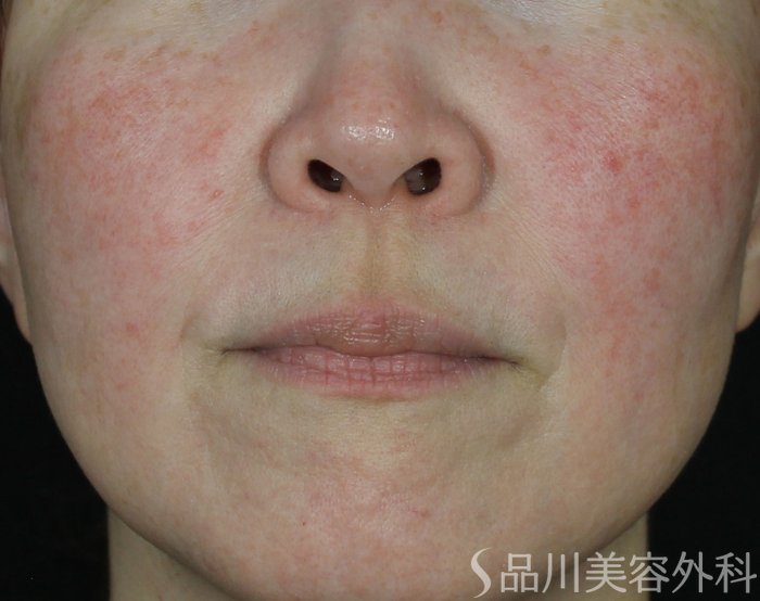 症例NO.70198のBEFORE写真