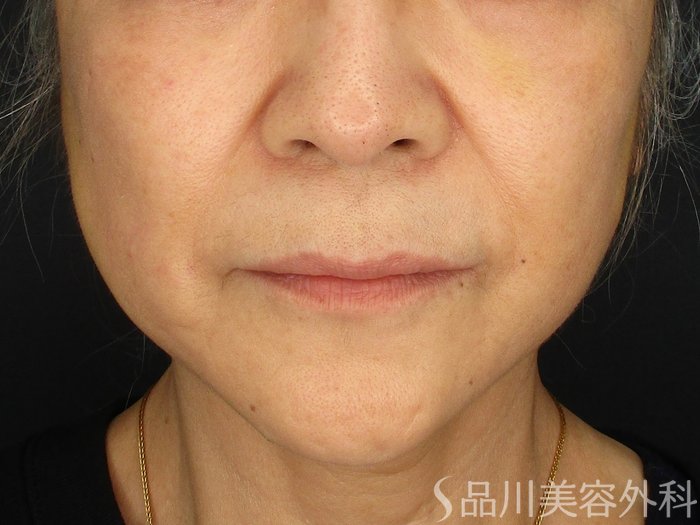 症例NO.73662のAFTER写真