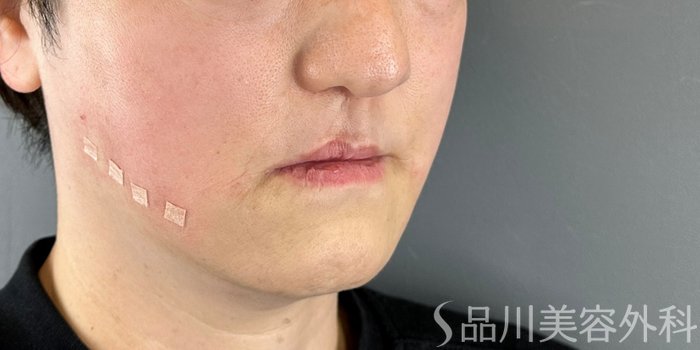 症例NO.73140のAFTER写真