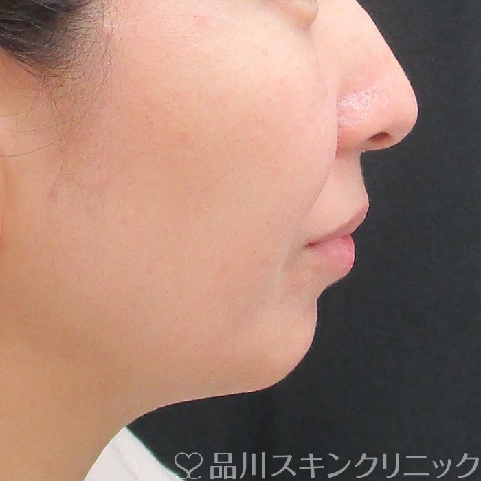 症例NO.73414のBEFORE写真