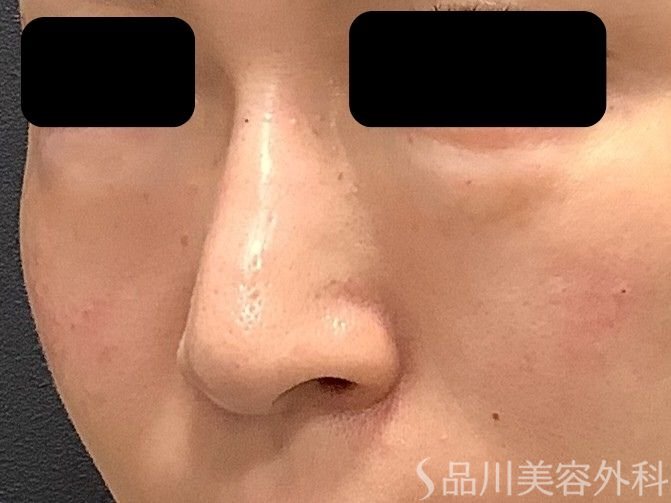 症例NO.75322のAFTER写真