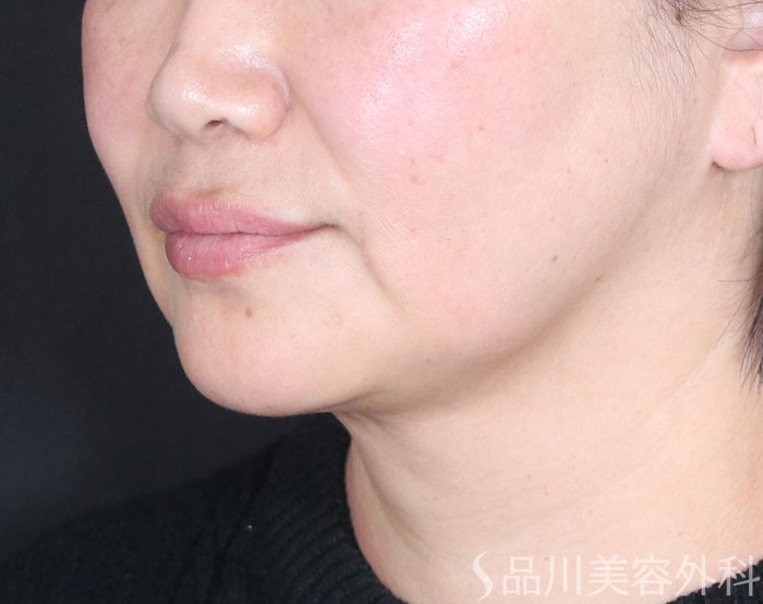 症例NO.72483のBEFORE写真