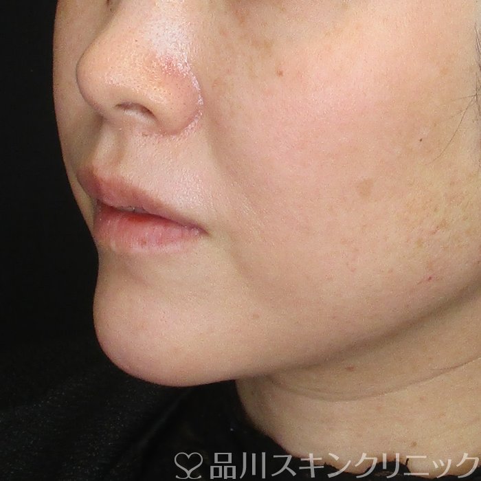 症例NO.73697のAFTER写真