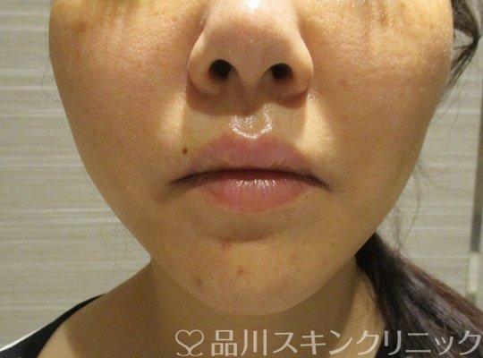 症例NO.73708のAFTER写真