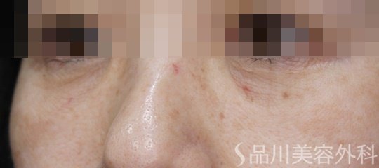 症例NO.72235のAFTER写真