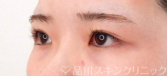 症例NO.62185のBEFORE写真