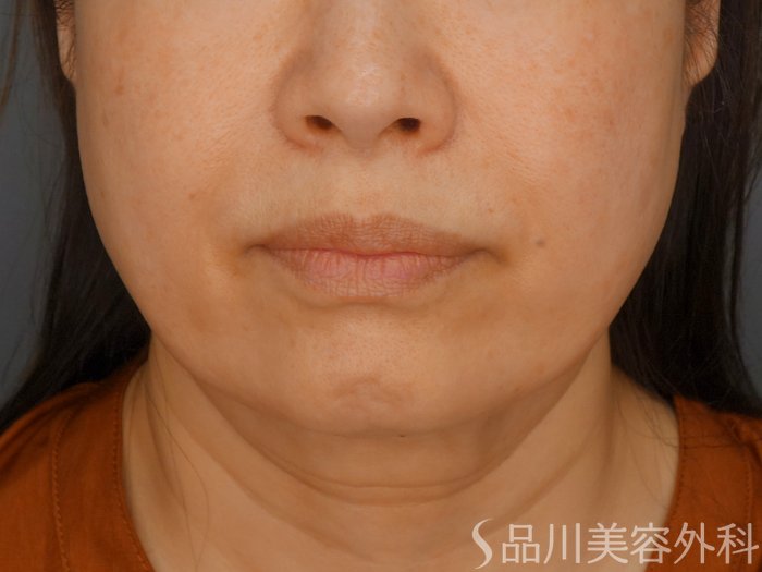 症例NO.70531のBEFORE写真
