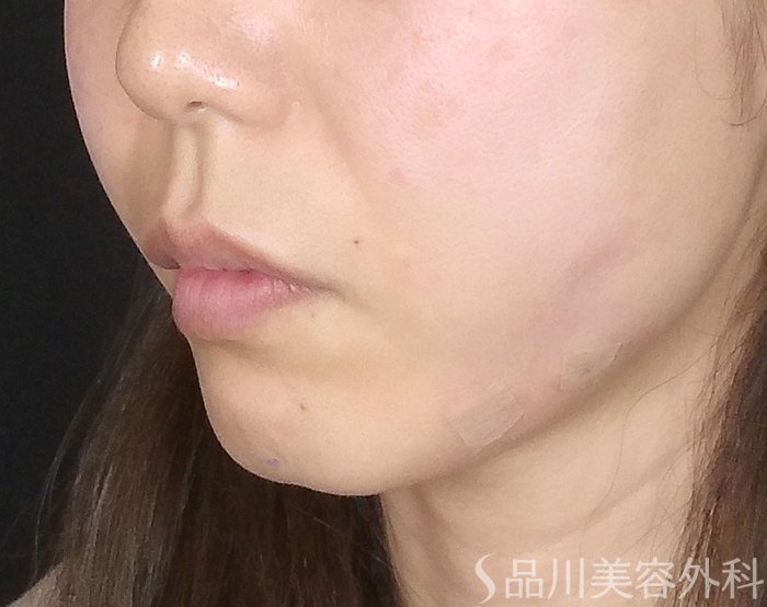 症例NO.69329のAFTER写真