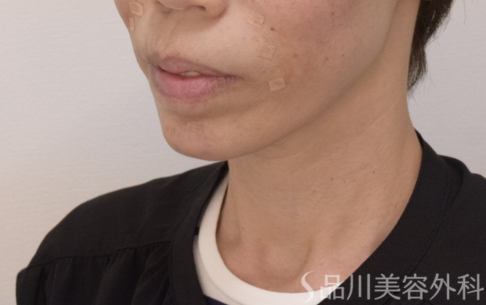 症例NO.71437のAFTER写真