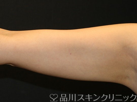 症例NO.71714のBEFORE写真