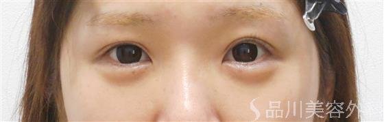 症例NO.31387のAFTER写真