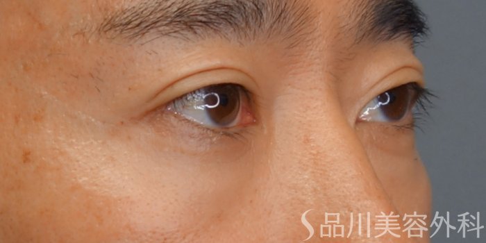 症例NO.73163のAFTER写真