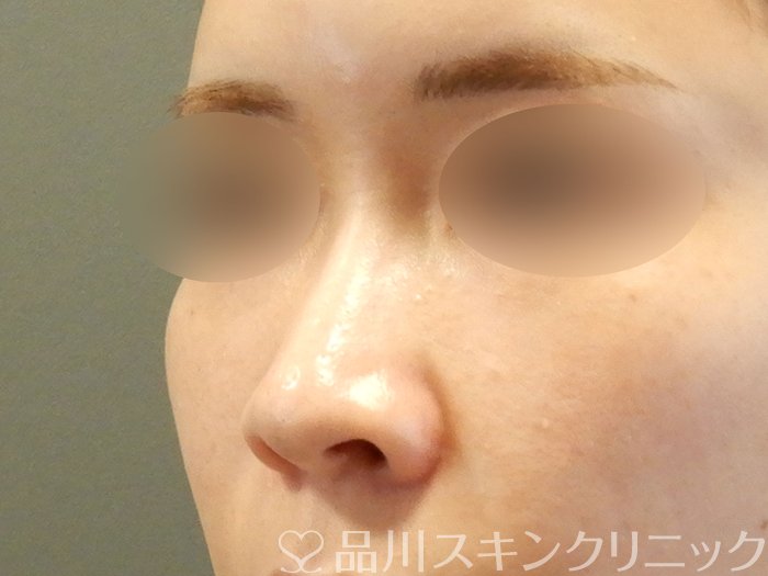症例NO.67960のBEFORE写真