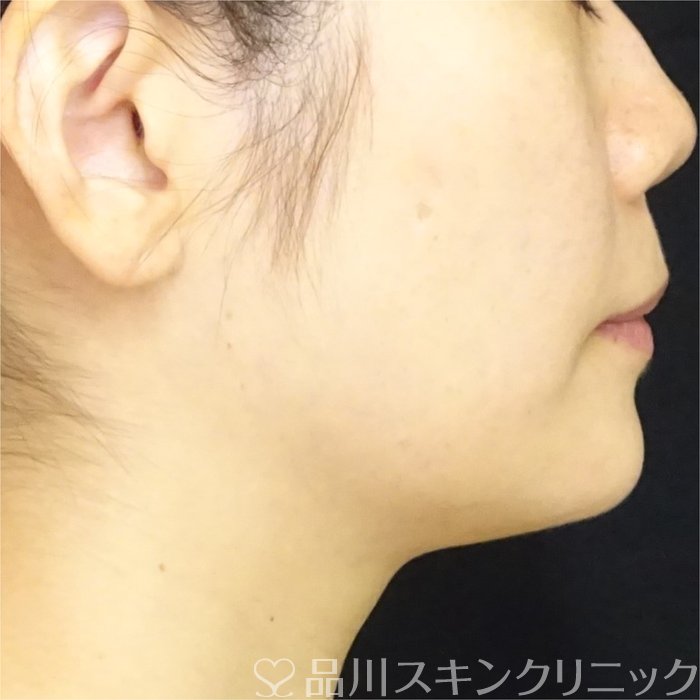 症例NO.69449のAFTER写真
