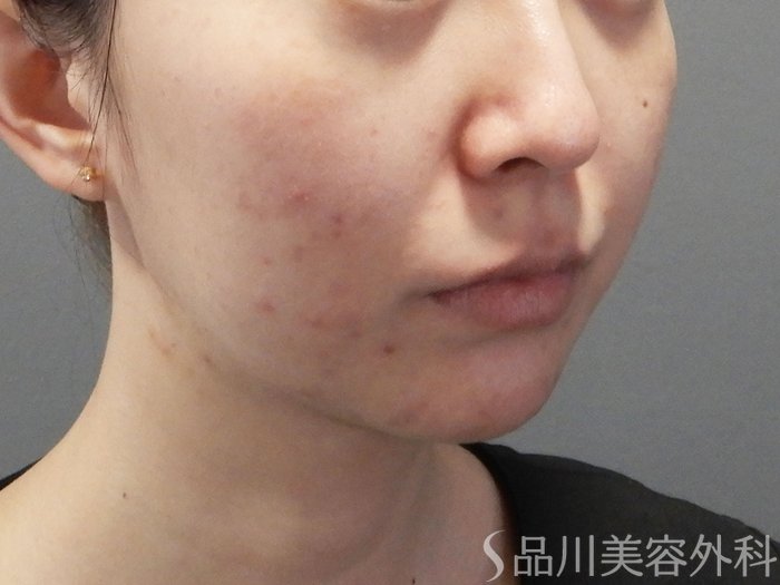 症例NO.72591のBEFORE写真