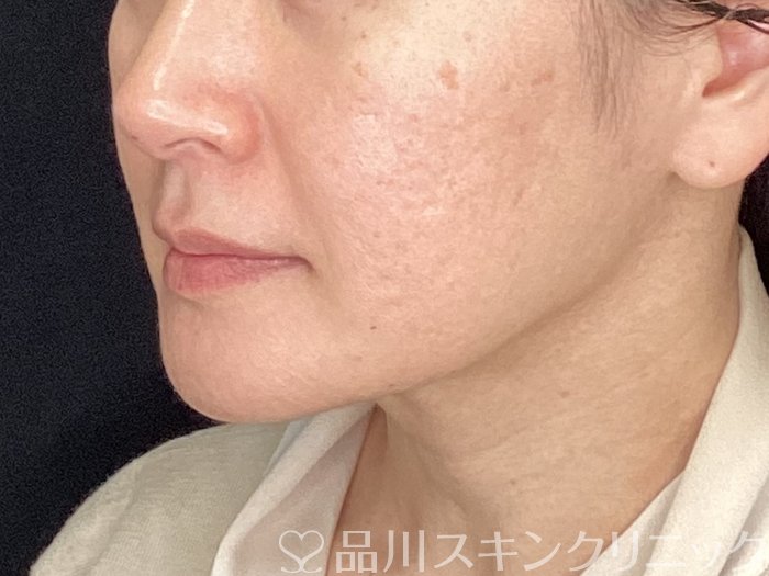 症例NO.64992のBEFORE写真
