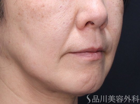 症例NO.74016のBEFORE写真