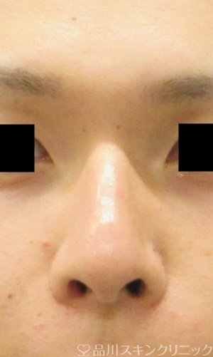 症例NO.65305のBEFORE写真