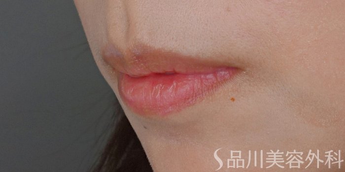 症例NO.72259のBEFORE写真