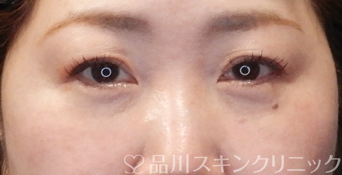 症例NO.63952のAFTER写真