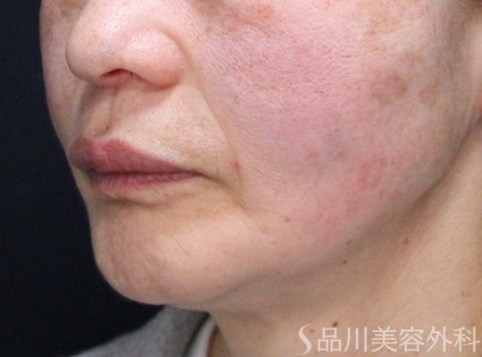症例NO.74095のAFTER写真