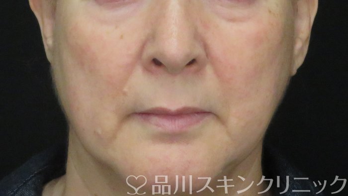 症例NO.71051のBEFORE写真