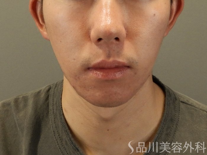 症例NO.65444のAFTER写真